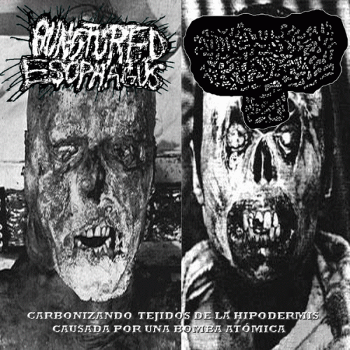 Carcinoma Basocelular : Carbonizando Tejidos de la Hipodermis Causada por una Bomba Atómica Carcinoma Basocelular : Carbonizando Tejidos de la Hipodermis Causada por una Bomba Atómica